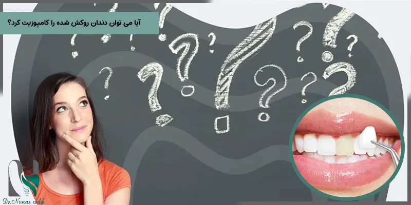 در پاسخ به این سوال باید گفت که نمی توان دندان روکش شده را کامپوزیت کرد، چرا که چسب مناسبی برای اتصال و پیوند کامپوزیت با روکش دندان وجود نداشته و تنها کامپوزیت ها توانایی اتصال به مینای دندان را دارند، و هم چنین طول عمر کامپوزیت های قرار گرفته بر روی روکش ها به مدت یک الی دو هفته می باشد. 