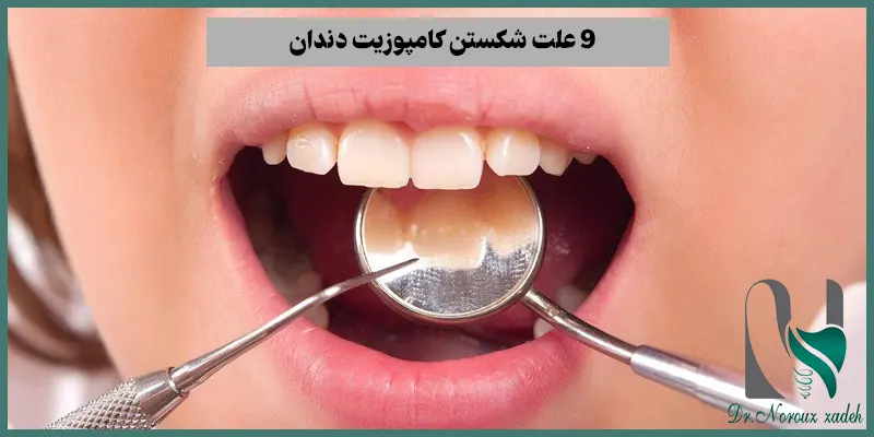 9-علت-شکستن-کامپوزیت-دندان