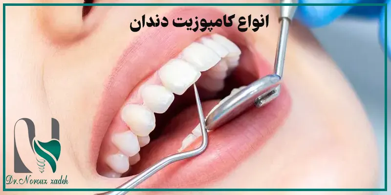 انواع-کامپوزیت-دندان-از-لحاظ-ساختار