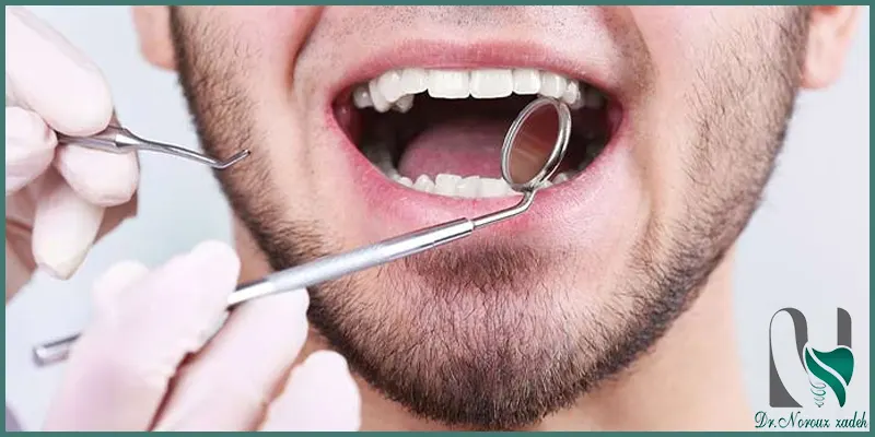تعویض-کامپوزیت-دندان-به-چه-صورت-است؟