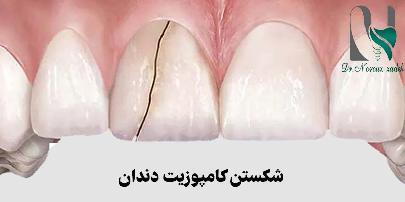 شکستن-کامپوزیت-دندان-و-علت-های-آن