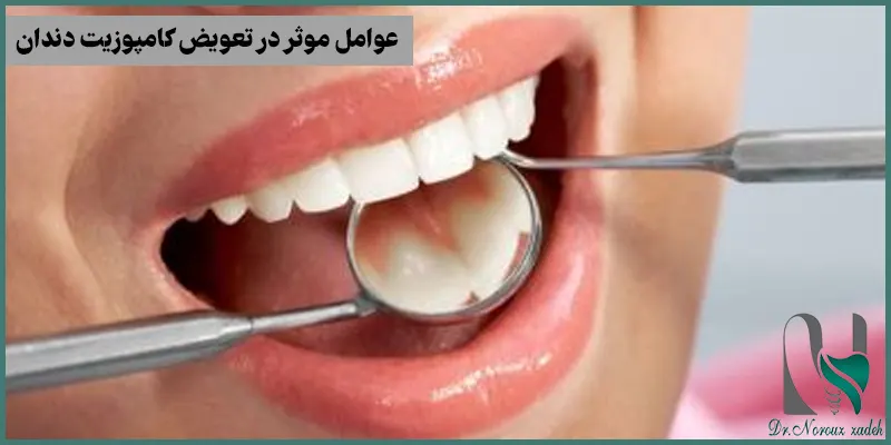 عوامل-موثر-در-تعویض-کامپوزیت-دندان