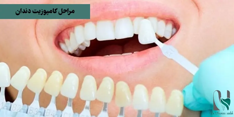 مراحل-کامپوزیت-دندان-را-نام-ببرید