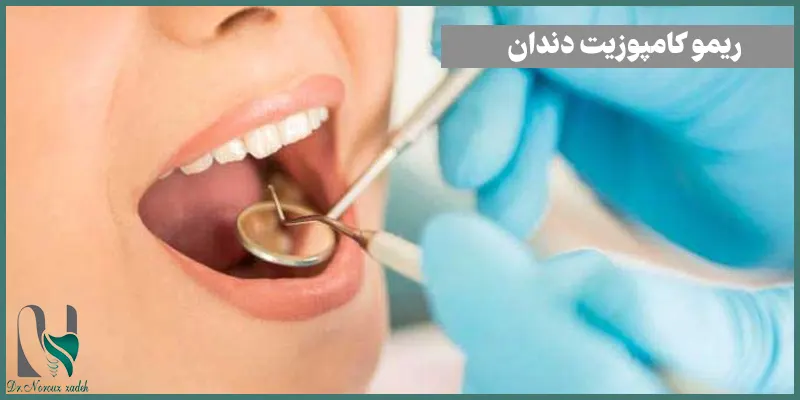 برداشتن-کامپوزیت-دندان