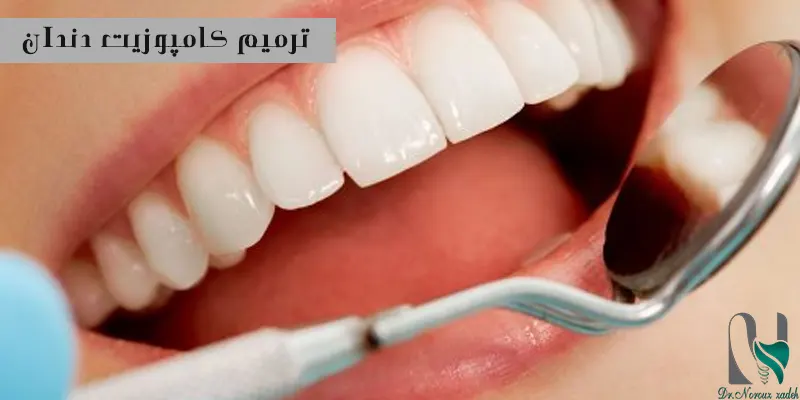 ترمیم-کامپوزیت-دندان-به-چه-صورت-است