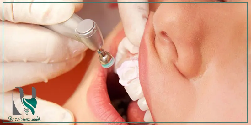 تکنیک-پولیش-دندان-بعد-از-کامپوزیت