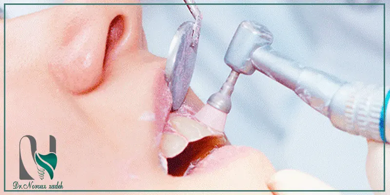 مراحل-انجام-پولیش-دندان-بعد-از-کامپوزیت