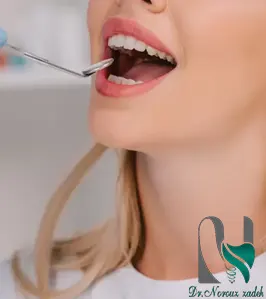 مراقبت-های-بعد-از-ترمیم-کامپوزیت