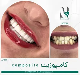 مقدمات-انجام-کامپوزیت-برای-دندان-های-کج