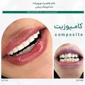 نمونه-کار-کامپوزیت-برای-دندان-های-کج