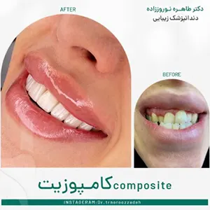 نمونه-کار-کامپوزیت-دندان-های-کج