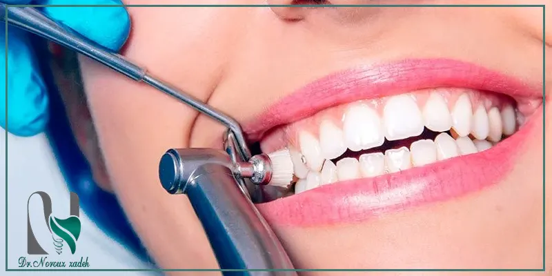 پولیش-دندان-بعد-از-کامپوزیت-دندان