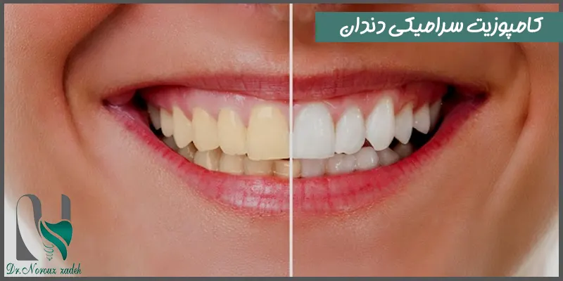کامپوزیت-سرامیکی-دندان