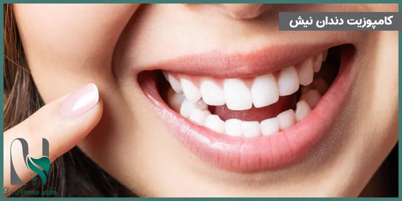 کامپوزیت-دندان-نیش