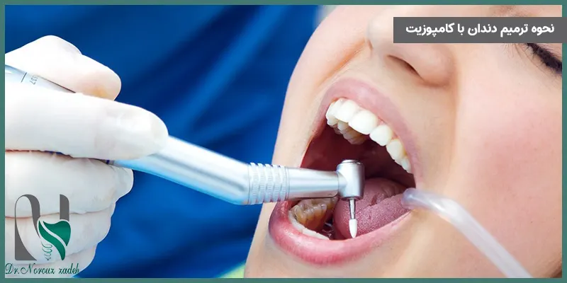 نحوه-ترمیم-دندان-پوسیده-با-کامپوزیت