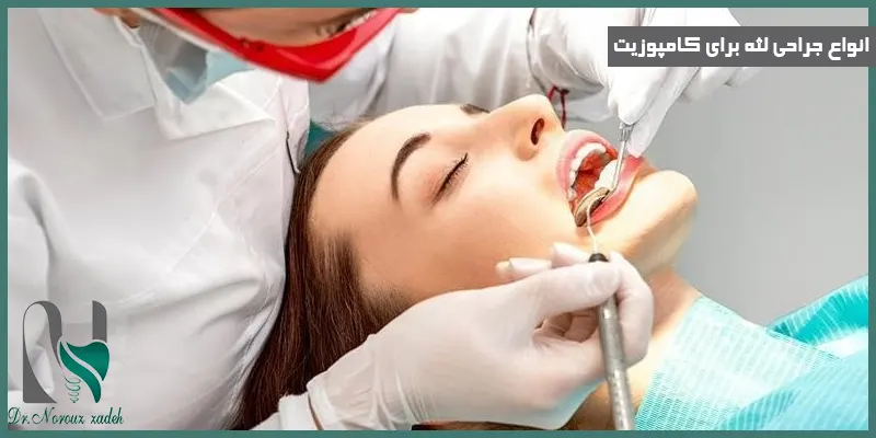 انواع-جراحی-لثه-برای-کامپوزیت