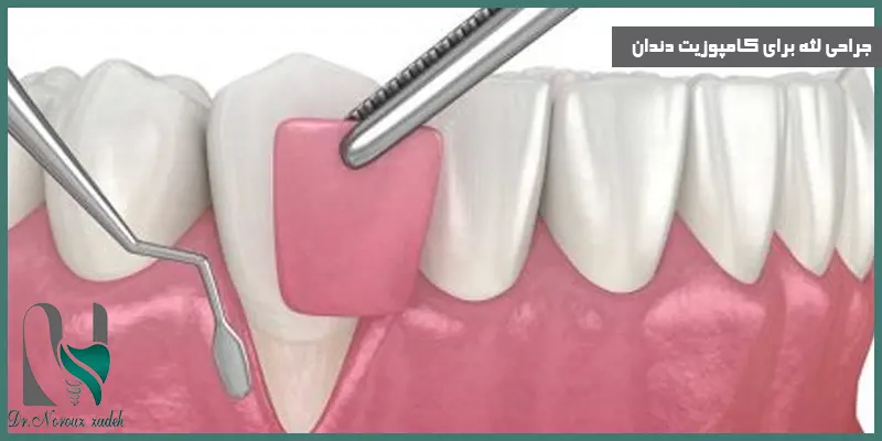 جراحی-لثه-برای-کامپوزیت