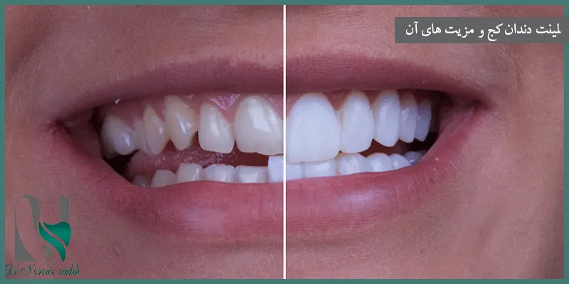 لمینت-دندان-کج-و-مزیت-های-آن
