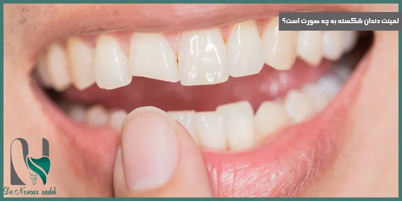 لمینت-دندان-شکسته-به-چه-صورت-است؟